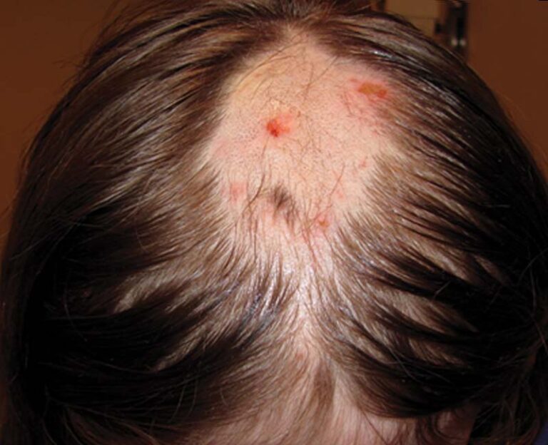 OCD and Hair Pulling: Understanding Comorbidity, Causes, and Treatment Options